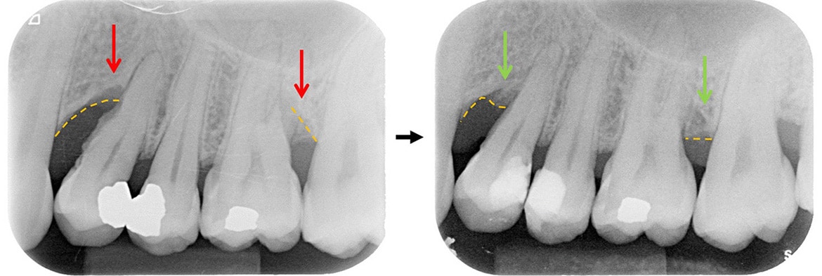 嚴重牙周病治療-雷射牙周治療-案例3-治療前後X光片-李晉成醫師-台中