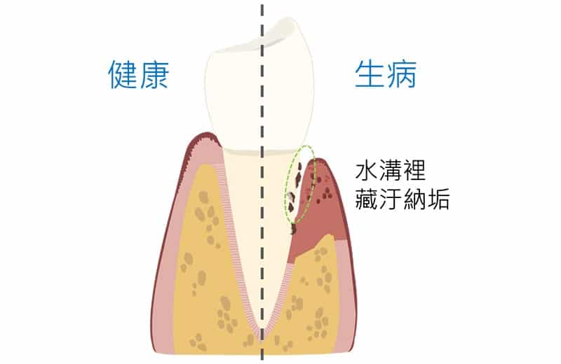 健康牙周組織-牙周病組織-牙周囊袋深處-細菌堆積