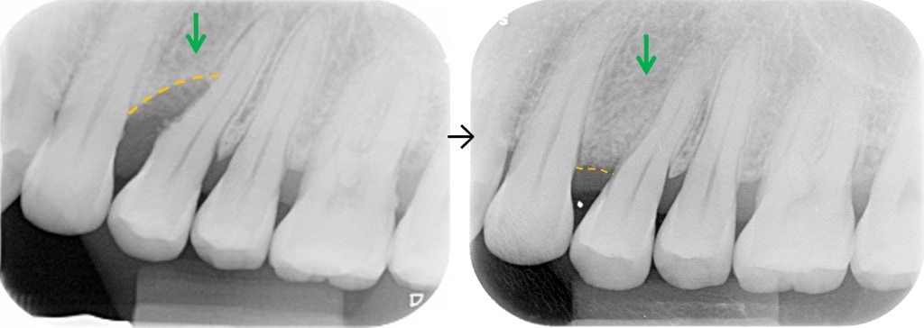 牙周病治療-補骨粉-補骨再生-治療效果前後對比
