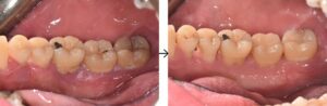牙周病治療-雷射牙周治療-雷射滅菌-治療效果前後對比