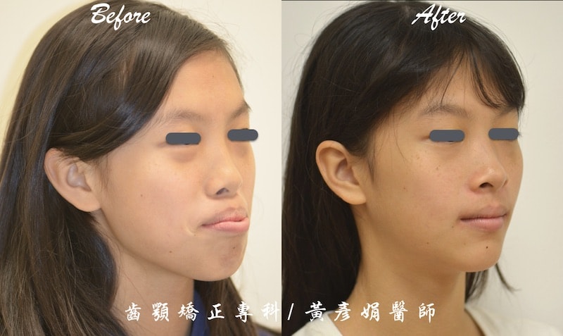 矯正骨釘治療暴牙合併笑齦 免正顎手術完成牙齒矯正案例 品維美學牙醫