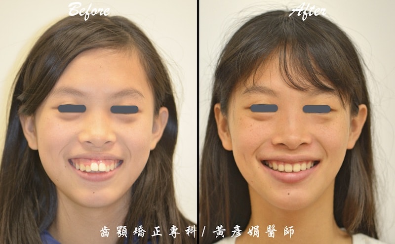 矯正骨釘治療暴牙合併笑齦 免正顎手術完成牙齒矯正案例 品維美學牙醫