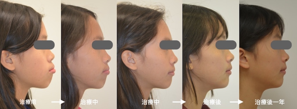 矯正骨釘治療暴牙合併笑齦 免正顎手術完成牙齒矯正案例 品維美學牙醫