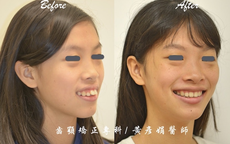 矯正骨釘治療暴牙合併笑齦 免正顎手術完成牙齒矯正案例 品維美學牙醫