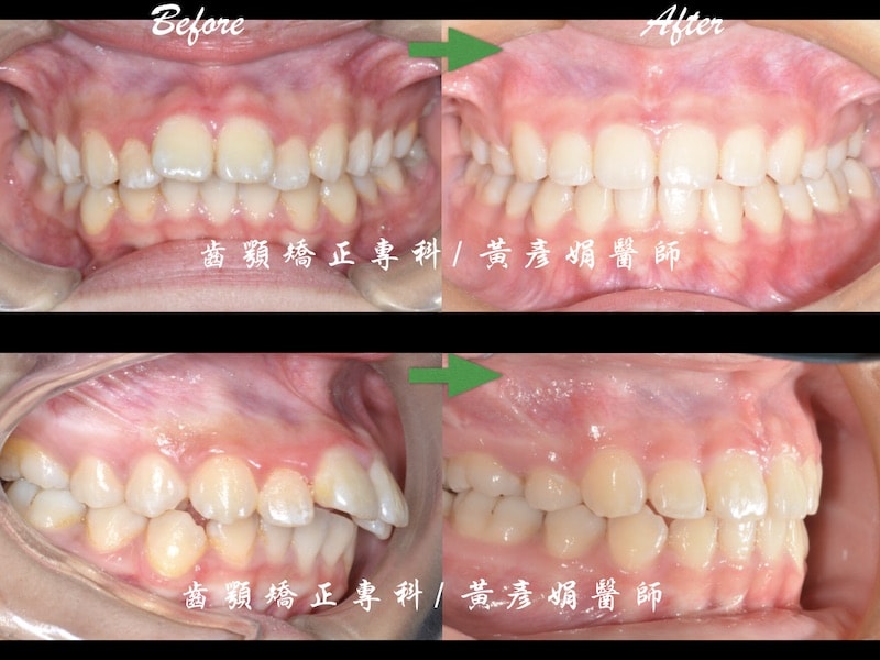 暴牙矯正-笑齦矯正-打骨釘-正顎手術-黃彥娟-台中牙齒矯正-暴牙與笑齦矯正的牙齒前後比較