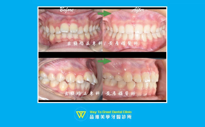 暴牙矯正案例-免正顎手術-骨暴-暴牙矯正-牙齒矯正前後-牙齒排列變化-台中牙齒矯正-推薦-品維美學牙醫