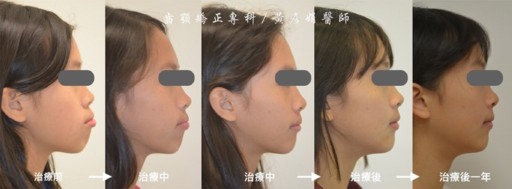 矯正骨釘治療暴牙合併笑齦 免正顎手術完成牙齒矯正案例 品維美學牙醫
