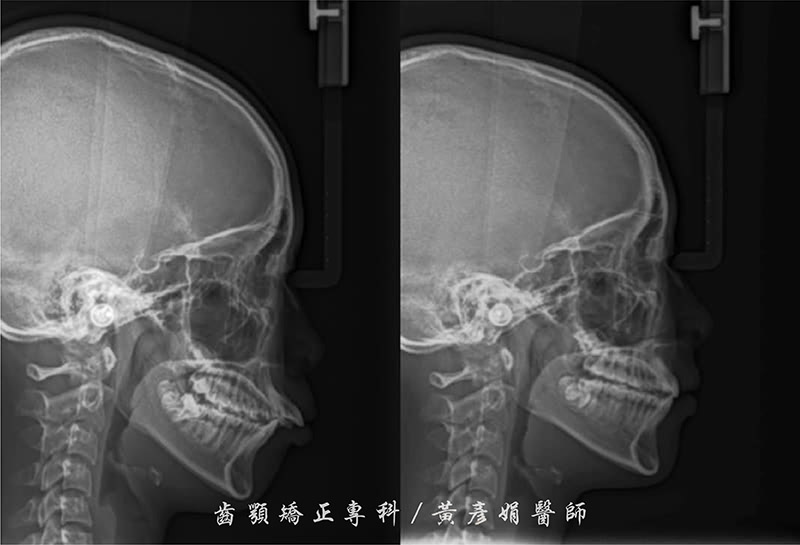 笑齦矯正-打骨釘-正顎手術-矯正前後X光對比-黃彥娟-牙齒矯正-台中